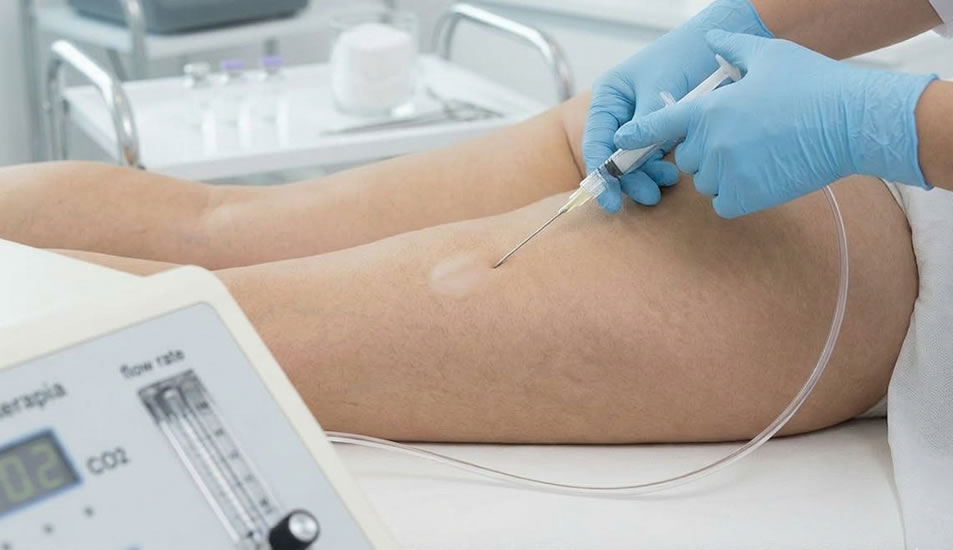 Carbossiterapia Piemonte